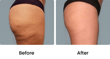 Endermologie: What to Know About the Cellulite Treatment